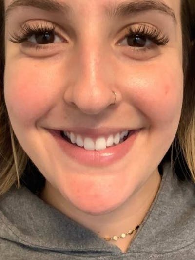 Botox / Dysport Before & After Gallery - Patient 217663 - Image 2
