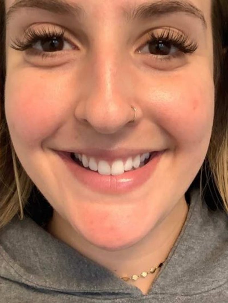 Botox / Dysport Before & After Gallery - Patient 217663 - Image 2