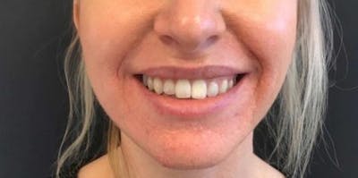 Botox / Dysport Before & After Gallery - Patient 415773 - Image 1