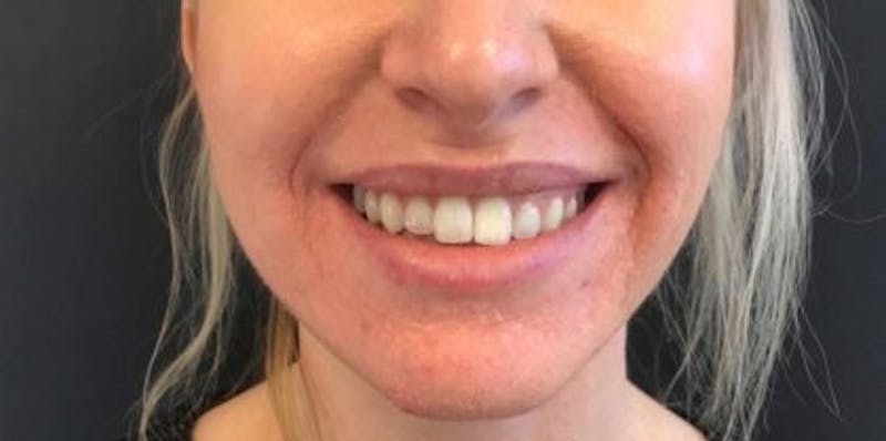 Botox / Dysport Before & After Gallery - Patient 415773 - Image 1