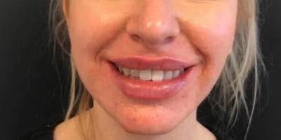 Botox / Dysport Before & After Gallery - Patient 415773 - Image 2