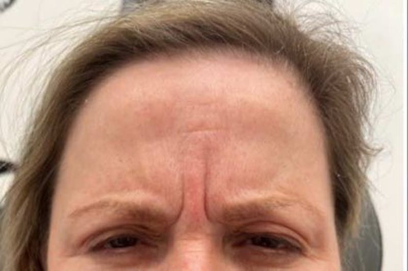 Botox / Dysport Before & After Gallery - Patient 395546 - Image 1
