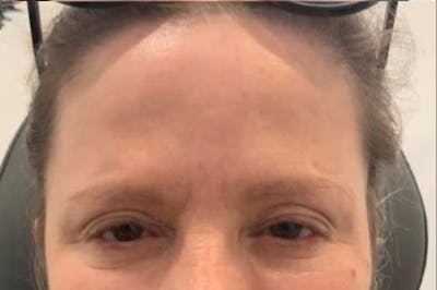 Botox / Dysport Before & After Gallery - Patient 395546 - Image 2