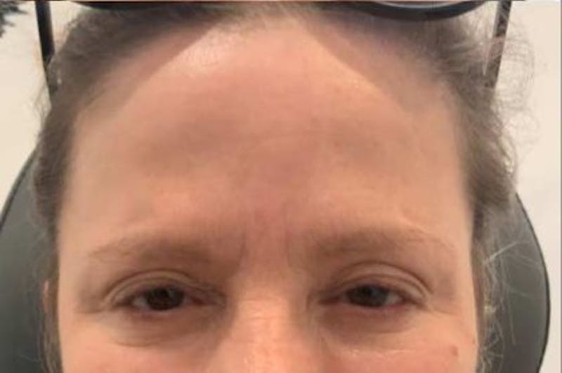 Botox / Dysport Before & After Gallery - Patient 395546 - Image 2