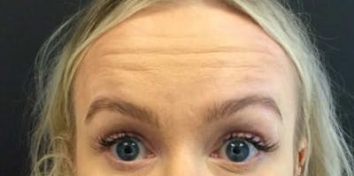 Botox / Dysport Before & After Gallery - Patient 116756 - Image 1