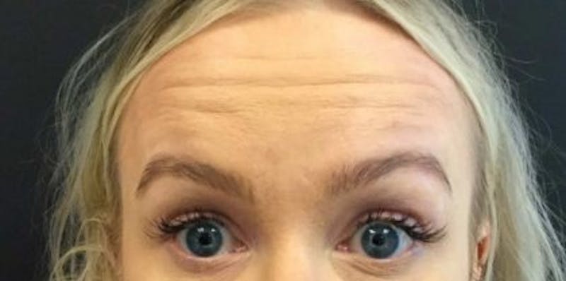 Botox / Dysport Before & After Gallery - Patient 116756 - Image 1