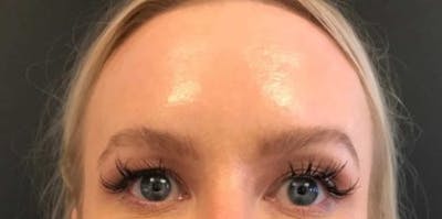 Botox / Dysport Before & After Gallery - Patient 116756 - Image 2