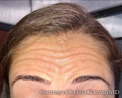 Botox / Dysport Before & After Gallery - Patient 936666 - Image 1