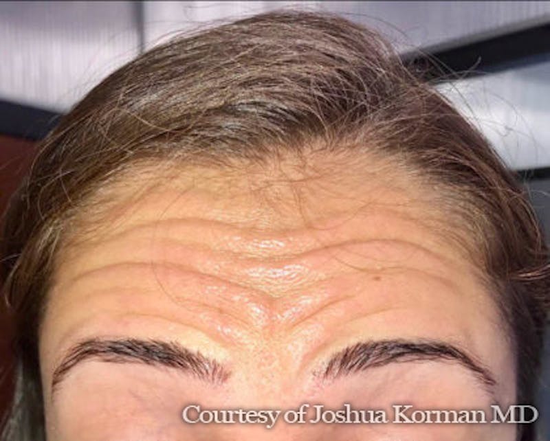 Botox / Dysport Before & After Gallery - Patient 936666 - Image 1