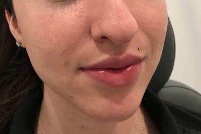 Juvederm / Voluma / Volbella / Kybella Before & After Gallery - Patient 217172 - Image 1