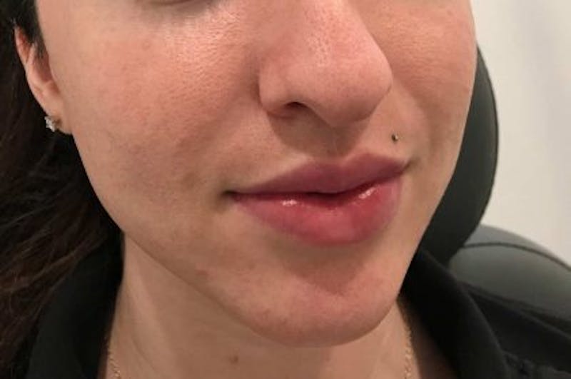 Juvederm / Voluma / Volbella / Kybella Before & After Gallery - Patient 217172 - Image 1