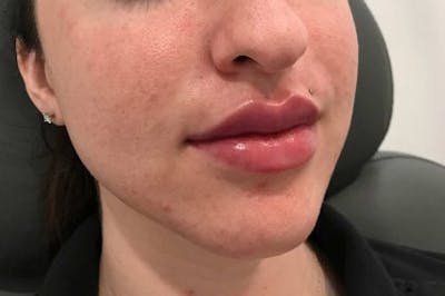 Juvederm / Voluma / Volbella / Kybella Before & After Gallery - Patient 217172 - Image 2