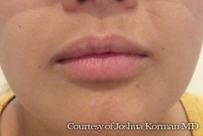 Juvederm / Voluma / Volbella / Kybella Before & After Gallery - Patient 143060 - Image 1