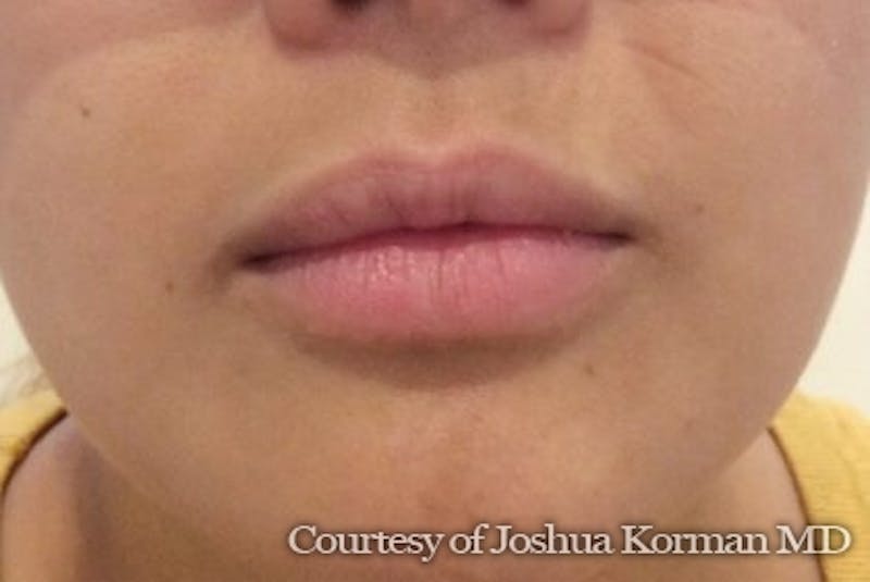 Juvederm / Voluma / Volbella / Kybella Before & After Gallery - Patient 143060 - Image 1