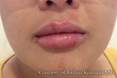 Juvederm / Voluma / Volbella / Kybella Before & After Gallery - Patient 143060 - Image 2