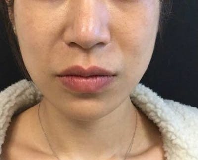 Nova Thread Lift Before & After Gallery - Patient 425293 - Image 1