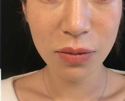Nova Thread Lift Before & After Gallery - Patient 425293 - Image 2