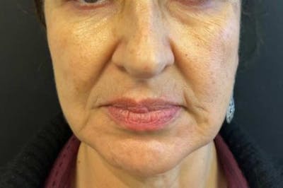 Nova Thread Lift Before & After Gallery - Patient 579941 - Image 1
