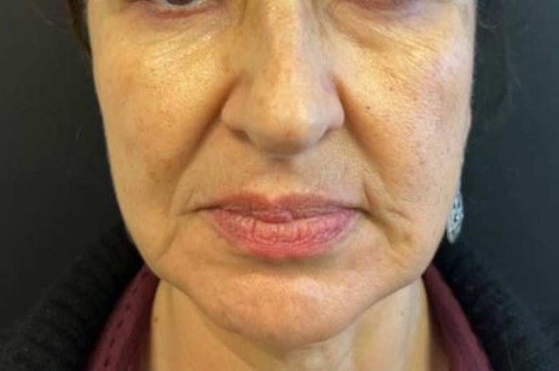 Nova Thread Lift Before & After Gallery - Patient 579941 - Image 1