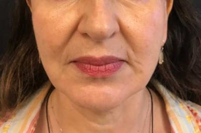Nova Thread Lift Before & After Gallery - Patient 579941 - Image 2