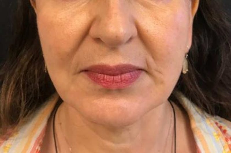 Nova Thread Lift Before & After Gallery - Patient 579941 - Image 2