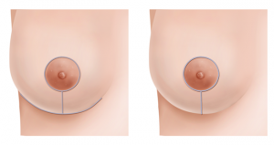 breast lift incision illustration