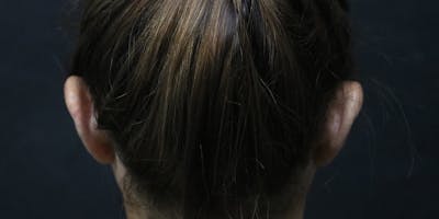 Otoplasty Before & After Gallery - Patient 270887 - Image 1