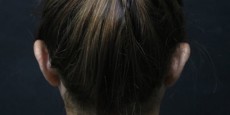 Otoplasty Before & After Gallery - Patient 270887 - Image 1