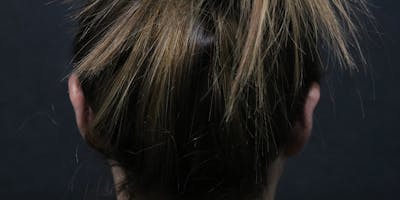 Otoplasty Before & After Gallery - Patient 270887 - Image 2