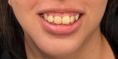 Botox / Dysport Before & After Gallery - Patient 307075 - Image 1