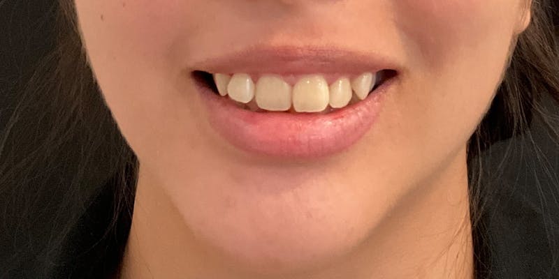 Botox / Dysport Before & After Gallery - Patient 307075 - Image 2