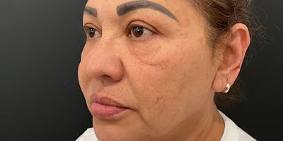 PicoWay Before & After Gallery - Patient 394213 - Image 1