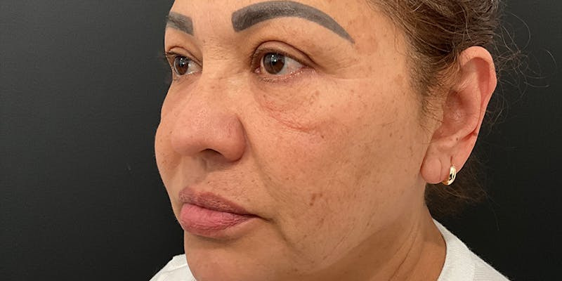 PicoWay Before & After Gallery - Patient 394213 - Image 1