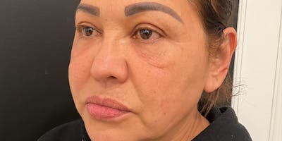 PicoWay Before & After Gallery - Patient 394213 - Image 2