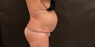 Weight Loss Shots Before & After Gallery - Patient 165484 - Image 1