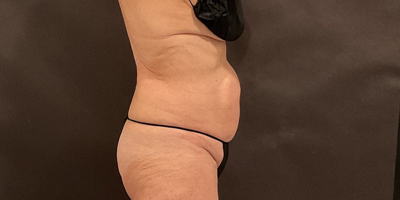Weight Loss Shots Before & After Gallery - Patient 165484 - Image 2