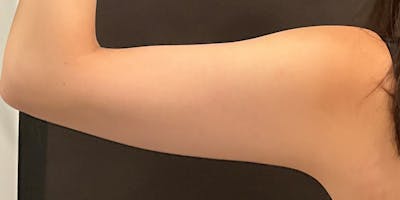CoolSculpting Before & After Gallery - Patient 286003 - Image 1