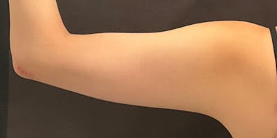 CoolSculpting Before & After Gallery - Patient 286003 - Image 2