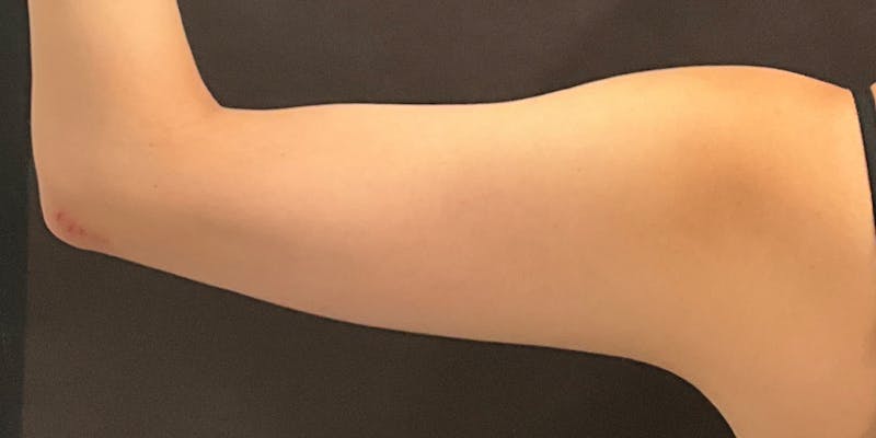 CoolSculpting Before & After Gallery - Patient 286003 - Image 2