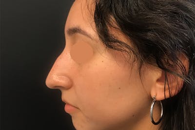 Liquid Rhinoplasty Before & After Gallery - Patient 403873 - Image 1