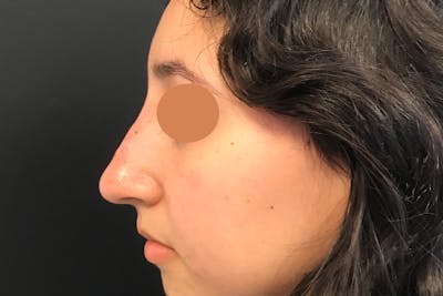 Liquid Rhinoplasty Before & After Gallery - Patient 403873 - Image 2