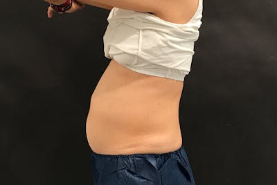 CoolSculpting Before & After Gallery - Patient 992544 - Image 1