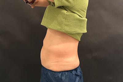 CoolSculpting Before & After Gallery - Patient 992544 - Image 2