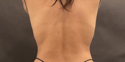 Weight Loss Shots Before & After Gallery - Patient 176848 - Image 2