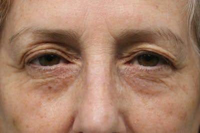 Eyelid Before & After Gallery - Patient 310550 - Image 1