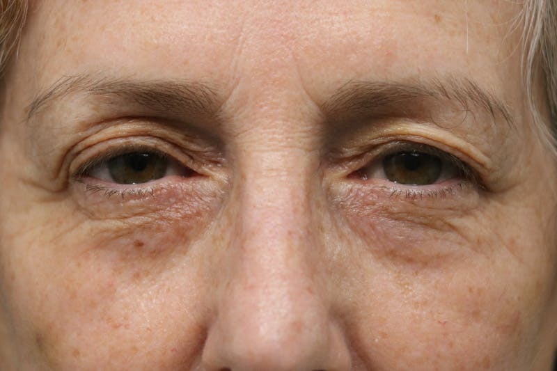 Eyelid Before & After Gallery - Patient 310550 - Image 1
