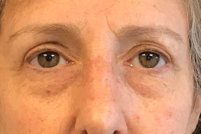 Eyelid Before & After Gallery - Patient 310550 - Image 2