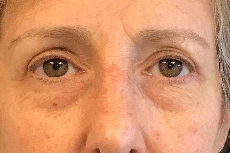 Eyelid Before & After Gallery - Patient 310550 - Image 2