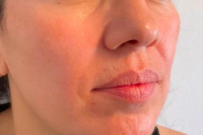 Juvederm / Voluma / Volbella / Kybella Before & After Gallery - Patient 345389 - Image 1