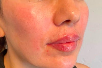 Juvederm / Voluma / Volbella / Kybella Before & After Gallery - Patient 345389 - Image 2